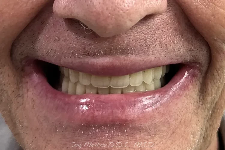 Snap on denture before and after Carrollton