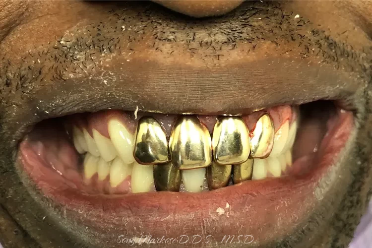 dental crown in fixing- n Carrollton