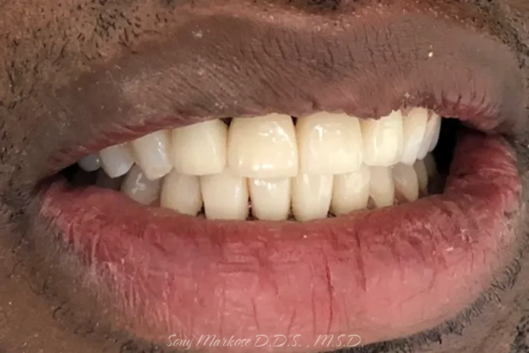 dental crown in fixing- n Carrollton