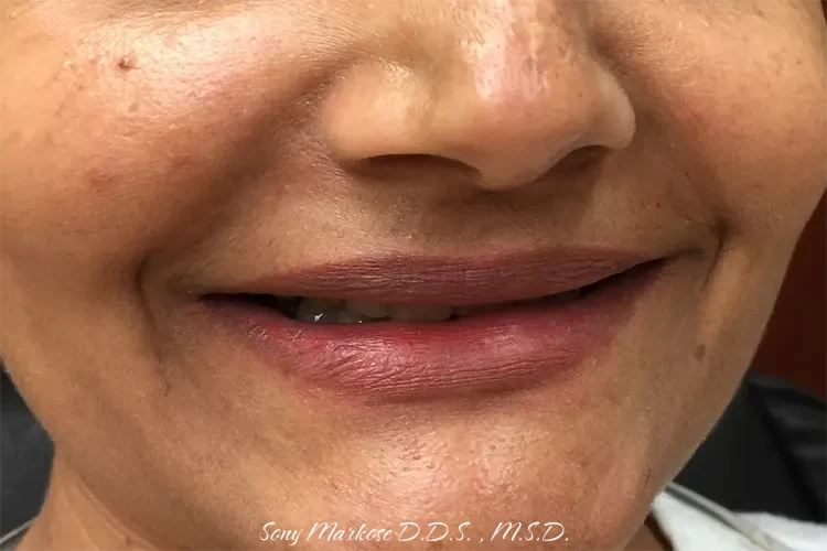 full mouth rehab in Carrollton before and after treatment