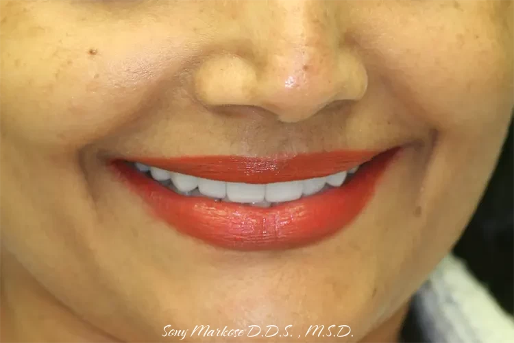 full mouth rehab in Carrollton before and after treatment