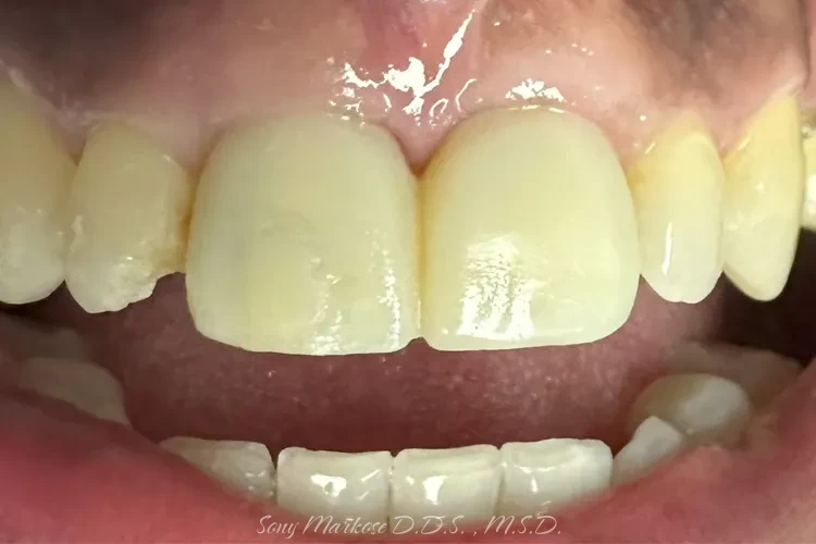 Dental Implants in Carrollton