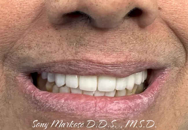 Hybrid Fixed Implant Denture in Carrollton