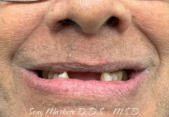 Hybrid Fixed Implant Denture in Carrollton