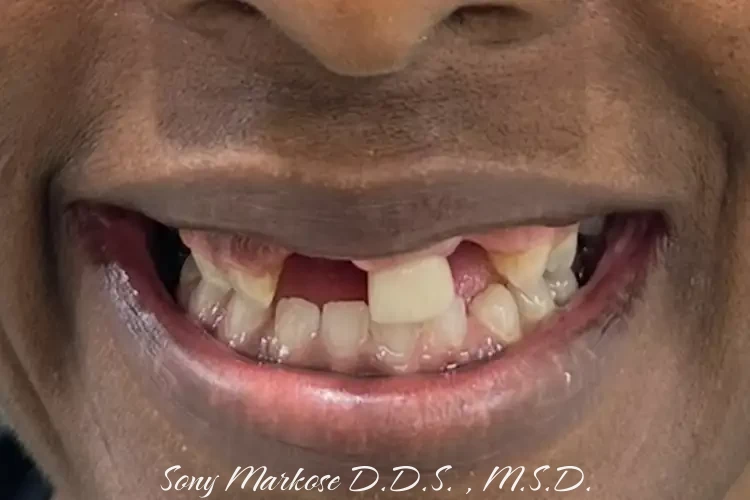 All on 4 Dental treatment in Carrollton