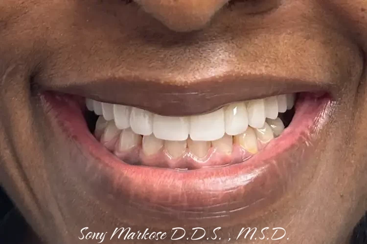 All on 4 Dental treatment in Carrollton